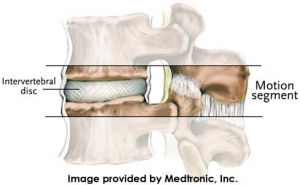 Medtronic_motionsegment_300_185_80