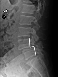 spondylolisthesis_189_253_80